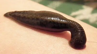 Bir garip olay: İnternette gördü denedi, şifa diye sülük kabusu yaşadı!