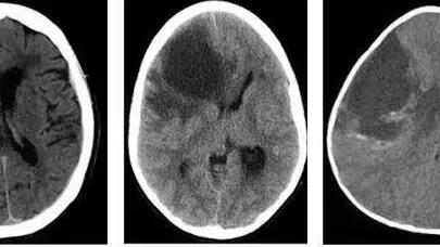 Radyoloji Raporlarında Geçen Hipodens Lezyon İfadesi