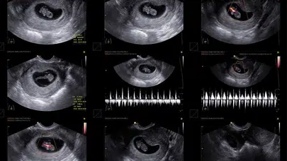 5 Haftalık Gebelikte Kese Görüntüsü Normal mi, Bebek Kaç mm ve Kaç Aylık?