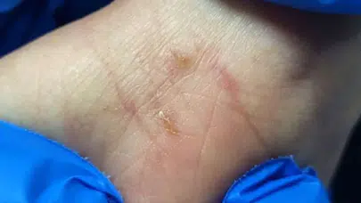 Sosyete uyuzu nasıl bulaşır, nedir, belirtileri neler, korunmak için neler yapılmalı, tedavisi ne?