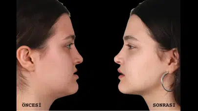 Çene estetiği sonrası nasıl bu kadar değişti, genç kadın neden bambaşka birine dönüştü, estetik yüz hatlarını nasıl etkiledi?