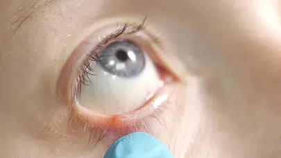 Kirpik dibi iltihabı neden olur, Saraçoğlu yöntemi işe yarar mı, evde ne yapılmalı?