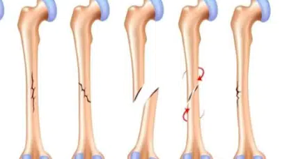 Uyluk neresi, uyluk kemiği vücudun hangi kısmında, ne işe yarar, neden önemlidir?