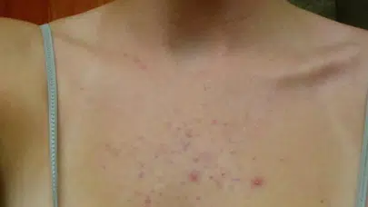 Yaz Sıcakları Göğüs Arasındaki Sivilceyi Artırıyor: Uzmanlardan Kritik Uyarılar