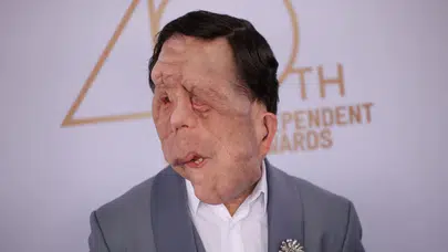 ADAM PEARSON HASTALIĞI NE! NF1 hastalığı nedir, Adam Pearson kimdir, yüzüne ne oldu, kaç yaşında?