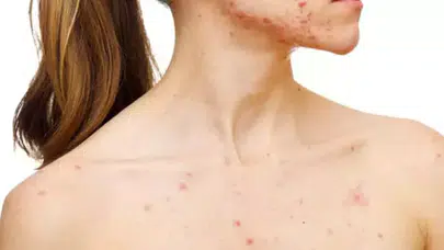 GÖĞÜS ETRAFINDA SİVİLCE Neden Olur, Nasıl Geçer, Hangi Tedavi Yöntemleri Etkili, Dermatolog Desteği Gerekir Mi?