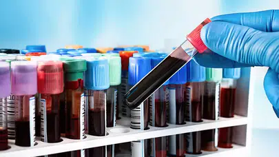 KAN TAHLİLLERİ ANLAMLARI NELERDİR? Kan Tahlili Nasıl Yapılır, Aç Karnına mı Yapılır, Değerleri ve Sonuçları Nasıl Yorumlanır?