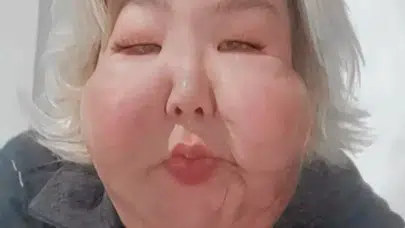 Ölümden dönmüştü! Ünlü fenomen yeniden bıçak altına yattı