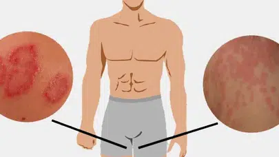 Tinea Cruris Hakkında Bilmeniz Gerekenler