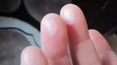 EL VE PARMAKTA SU TOPLAMASI NEDEN OLUR, NASIL GEÇER? Tedavi Yöntemleri Neler, Nasıl Önlenir?