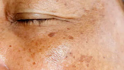 YÜZDE KAHVERENGİ BENLER NEDEN ÇIKAR? Nasıl geçer, etkili yöntemler, doğal çözümler ve tedavi seçenekleri neler?