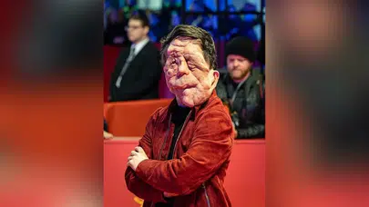 ADAM PEARSON KİMDİR, HASTALIĞI NE? Yüzüne ne oldu, filmleri ve hayatı