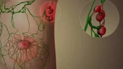 YAĞLI HİLÜS NEDİR, LENNF NODLARI İLE İLİŞKİSİ NE? Büyümesi belirtileri neler, tedavi yöntemleri neler?