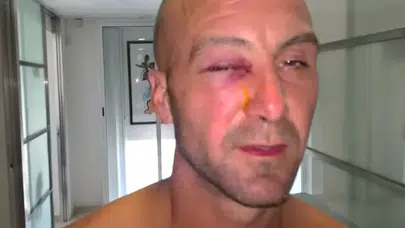 Havuzda Oyun Felakete Döndü! Saniyeler İçinde Kör Oldu