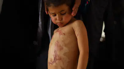 Katil İsrail’in 'tıbbi kısıtlaması' Gazze’yi vurdu: 3D yazıcı parçaları bile yasaklı listesinde!