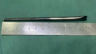 Röntgenine bakan doktorlar gözlerine inanamadı... Boğazından çıkan şey 8 yıllıkmış!