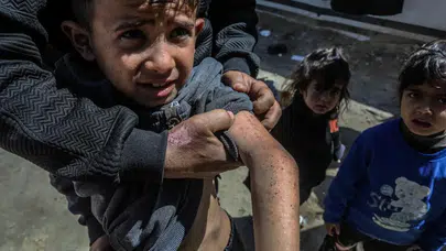 Gazze'de 'görünmez katil' alarmı: Ölü sayısı 72 bini aşarken salgın kapıya dayandı!