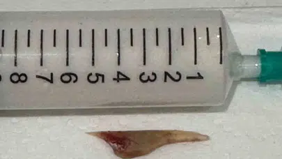 Boğazına saplanan 5 santimlik kemik öldürüyordu