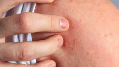 Histamin İntoleransı nedir? her yemekten sonra yaşanan ani şişkinlik, kaşıntı ve yüzde kızarıklık neden olur?
