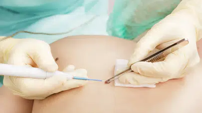 Ben aldırmak sakıncalı mı? Kansere neden olur mu? Dermatologların önerdiği tedavi süreçleri nelerdir?
