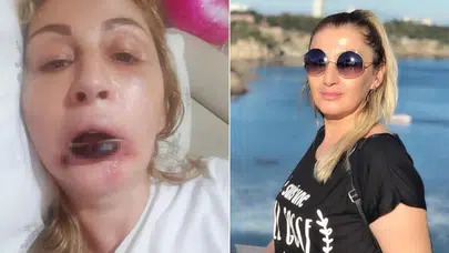 Güzellik uğruna kararan bir hayat: 4 kez bıçak altına yattı, dudağını kaybetti!