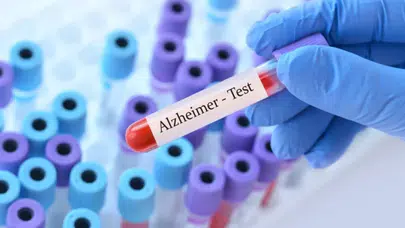 p-tau217 kan testi nedir? Alzheimer riskini nasıl tahmin eder, ne zaman çıkacak ve kimlere uygulanacak?