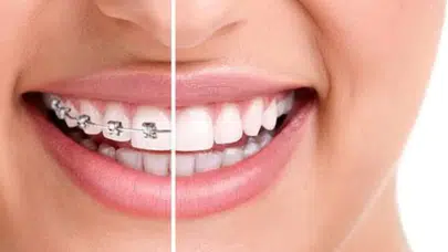 Ortodonti nedir? Nasıl yapılır, tedavisi kaç yıl sürer, kimler için gereklidir, şeffaf plak mı metal tel mi, yaş sınırı var mı?