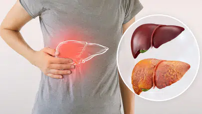Karaciğer yağlanması nedir? Belirtileri nelerdir, neden olur, nasıl tedavi edilir?