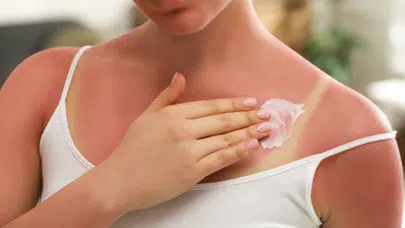 Güneş yanığına ne iyi gelir? Nasıl geçer, ne sürülmeli, leke kalır mı, kaç günde iyileşir?