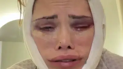 Didem Ceran estetik sonrası isyan etti! Son hâli gündem oldu
