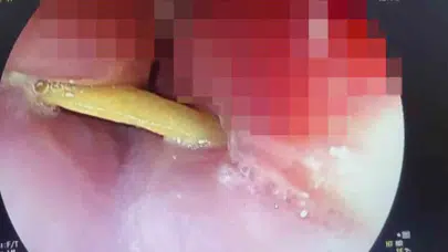 Yemek yerken kabusu yaşadı: 5 santimlik kemik boğazına saplandı