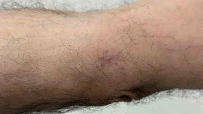Dirseğindeki küçük yarayı önemsemedi, hayatını değiştiren gerçeği hastanede öğrendi: Meğer kansermiş