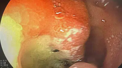 Mide ağrısıyla gitti, hayatının şokunu yaşadı: Doktorlar bile gözlerine inanamadı