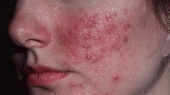 Gül Hastalığı (Rozasea) Nedir, Hangi Ciltlerde Sık Görülür, Belirtileri, Türleri, Tedavisi?
