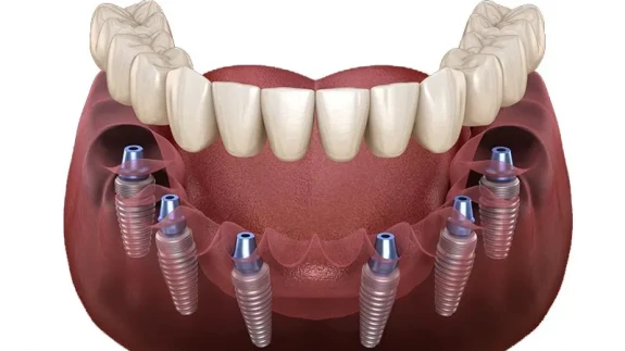 Kemik Kaybına Götüren Sessiz Düşman