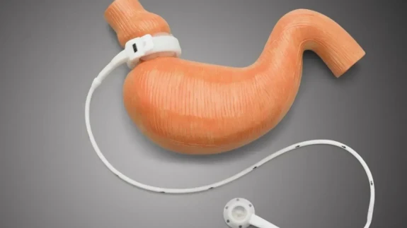 Mide Bandı Uygulamasıyla Obeziteyle Mücadelede Yeni Umut