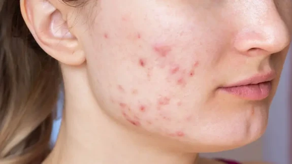 Yüzdeki Akne Yeme Bozukluklarını Tetikleyebilir: Yale Üniversitesi'nden Uyarı