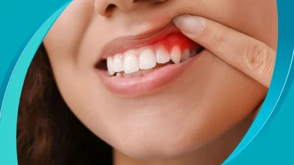 Diş Apsesi Hayati Tehlike Taşıyabilir!