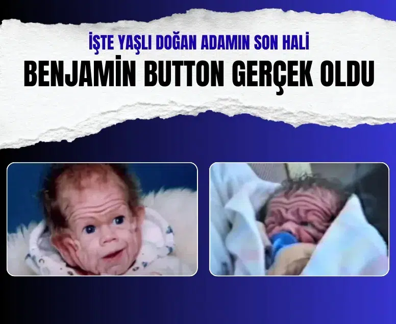 Benjamin Button vakası! İşte yaşlı doğan adamın son hali