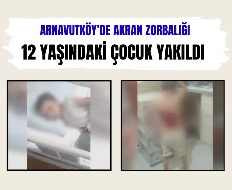 Arnavutköy’de akran zorbalığı: 12 yaşındaki çocuk yakıldı