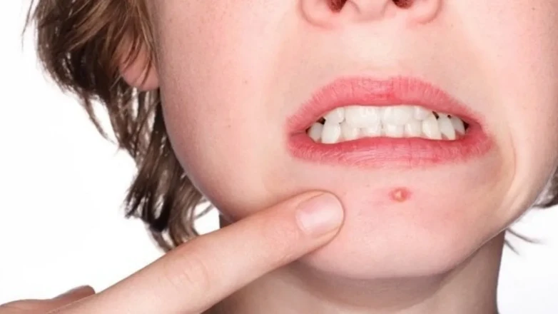 Sivilceleri Yok Etmenin Doğal Yolları Nelerdir? Evde Uygulayabileceğiniz 6 Etkili Çözüm!