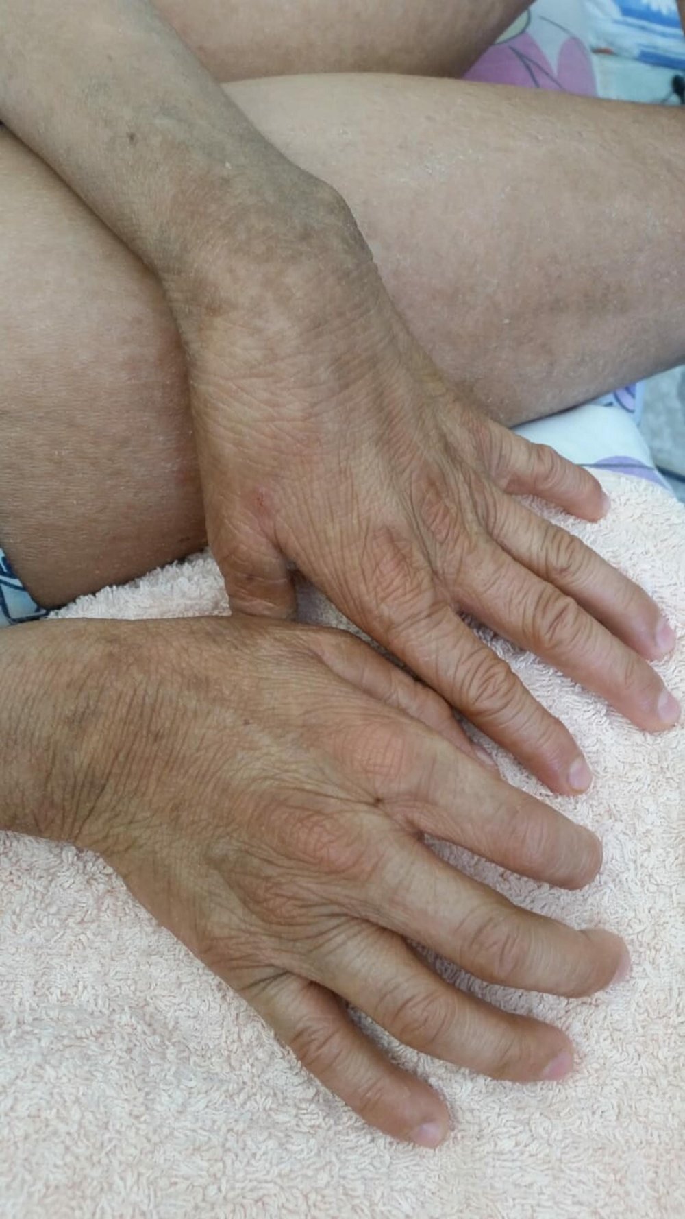 Gündüzleri evden çıkamıyor: 'İlaçları kullanmadan uyuyamıyorum'