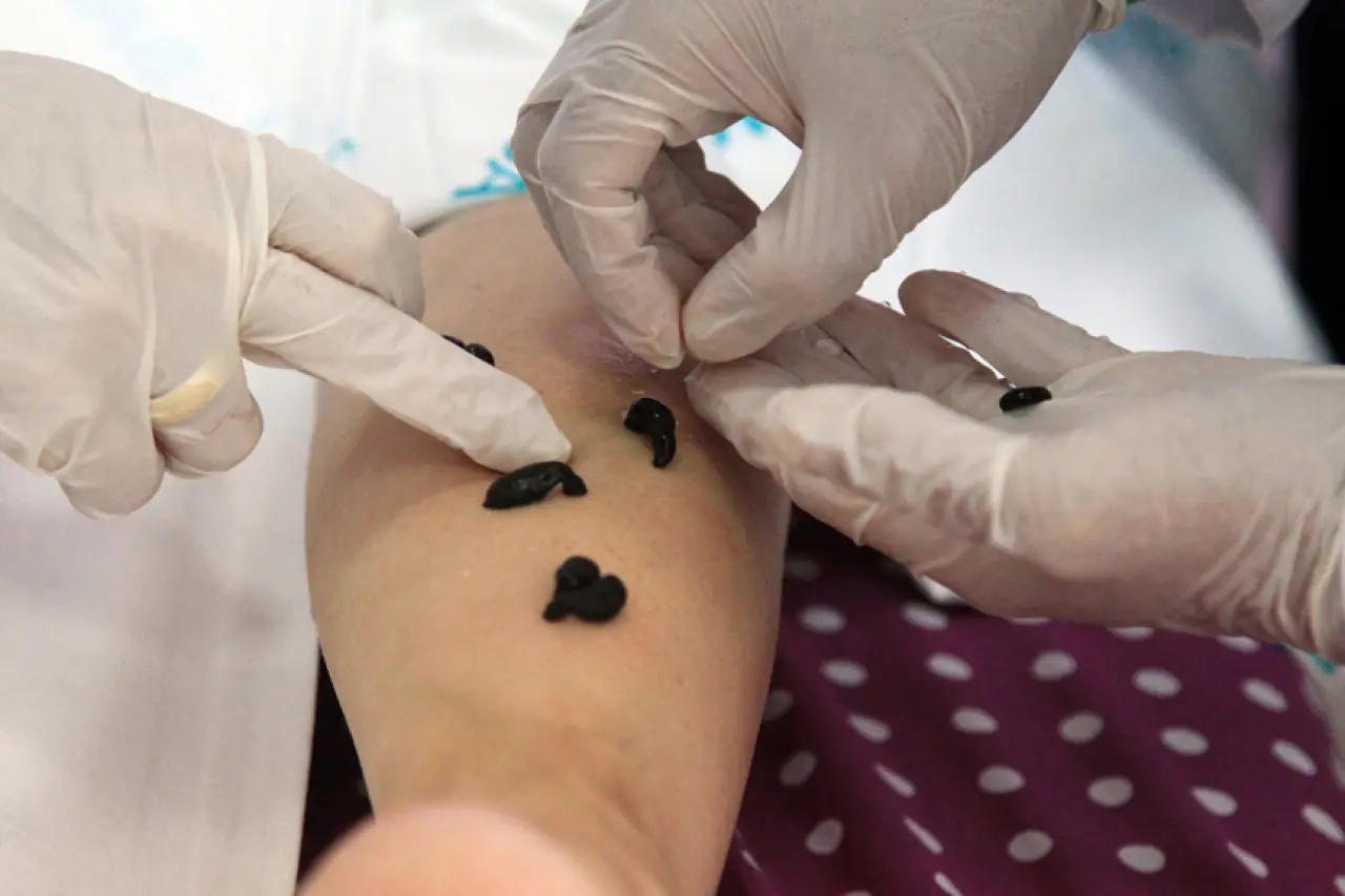 Sülük Salgısından Yeni Tedavi Yolda: MS ve Romatizma Hastalarına Umut Olabilir 1