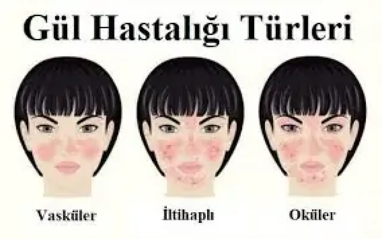 Gül Hastalığı (Rozasea) Nedir, Hangi Ciltlerde Sık Görülür, Belirtileri, Türleri, Tedavisi? 4