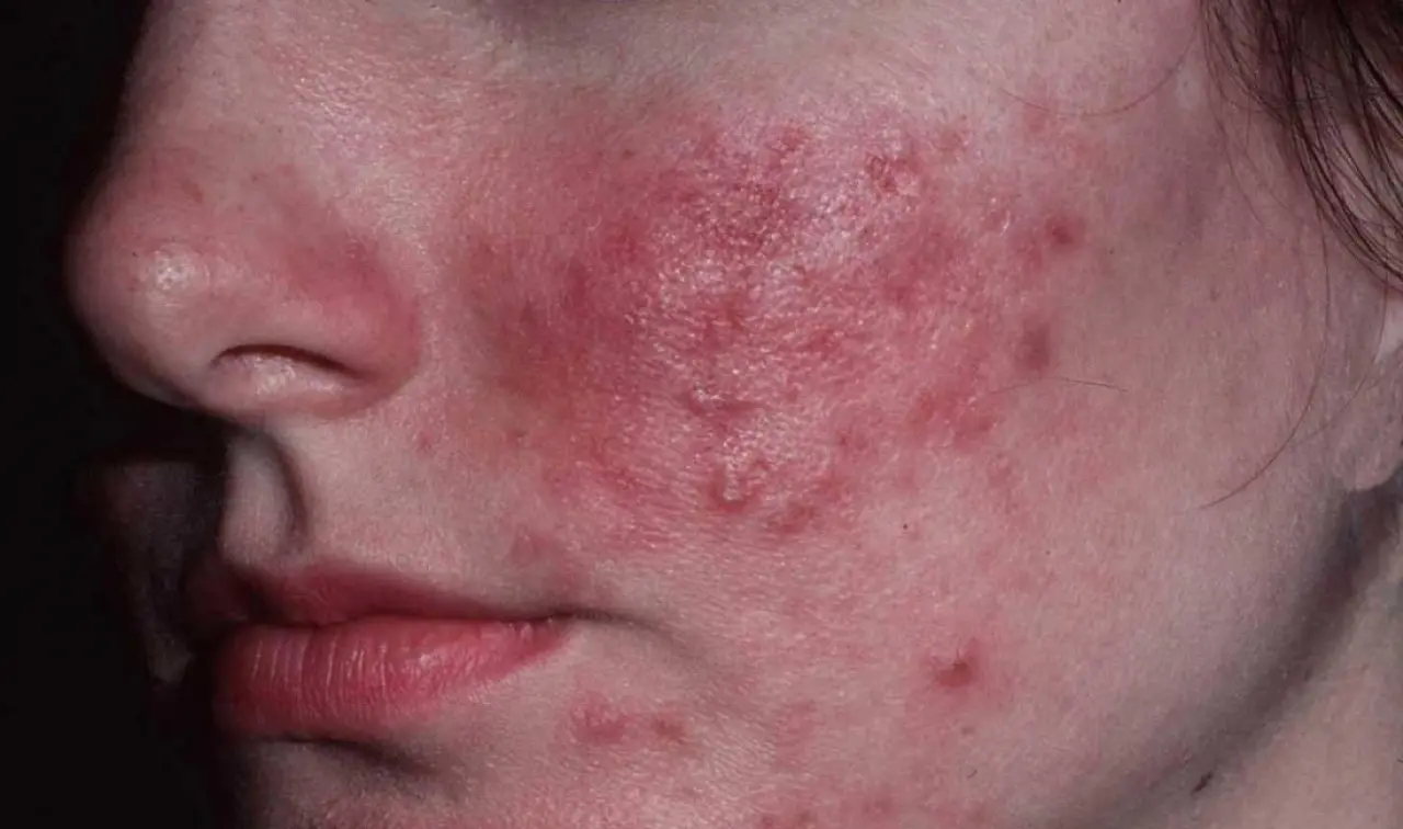 Gül Hastalığı (Rozasea) Nedir, Hangi Ciltlerde Sık Görülür, Belirtileri, Türleri, Tedavisi? 1