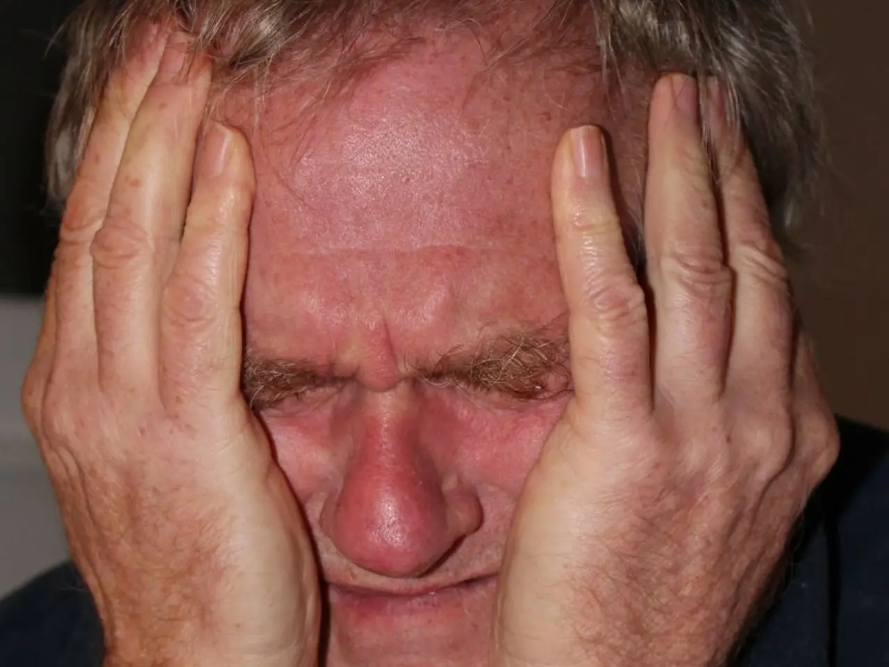 Gül Hastalığı (Rozasea) Nedir, Hangi Ciltlerde Sık Görülür, Belirtileri, Türleri, Tedavisi? 3