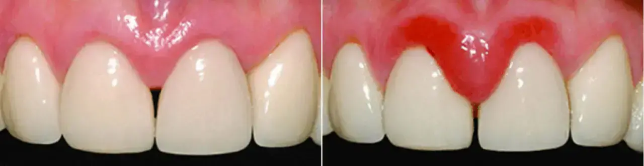 Dişleriniz Sağlığınızı Gözler Önüne Seriyor: Bakım ve Beslenmenin Önemi! 2