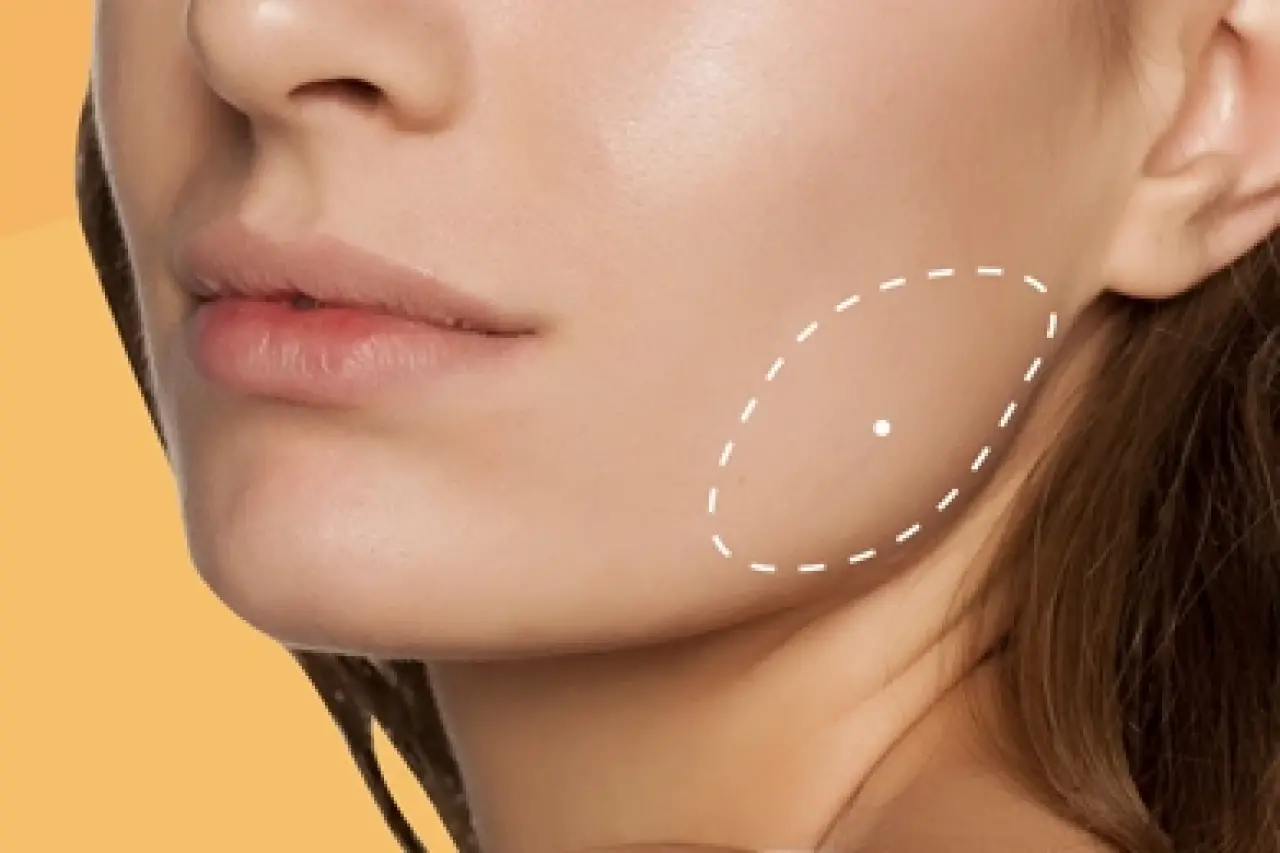 Diş Sıkmaktan Kurtulmanın En Etkili Yolu: Masseter Botoksu Mucizesi! 2