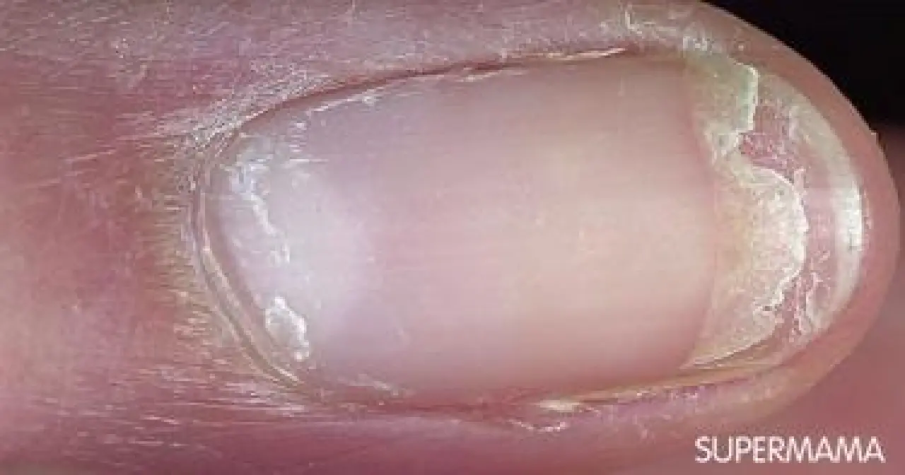 Soluk, Sarı, Mavi... Tırnaklar Ne Söylüyor? 6