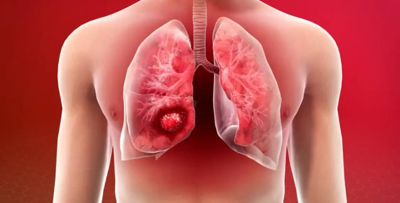 Akciğer Kanseri: Sessiz Başlayan, Ölümcül Seyreden Tehlike 1
